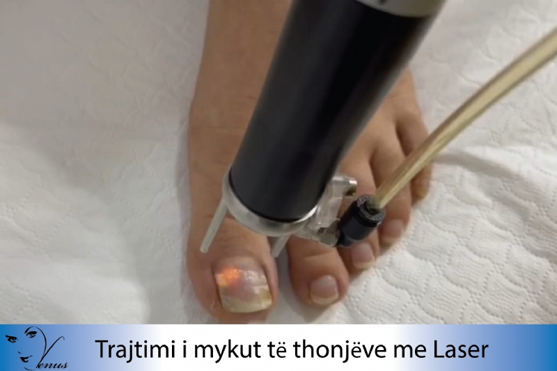 Trajtim i kapilareve me Laser, Trajtimi mykut te thonjeve me Laser, Trajtimi Akne Rosacea me IPL, Trajtimi Aknes me Laser, Trajtimi Renies se Flokeve, Plazem per trajtimin e renies se flokeve, Laser Fraxtional CO2